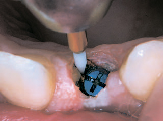 Триммер мягких тканей 249-016-FG - раскрытие импланта